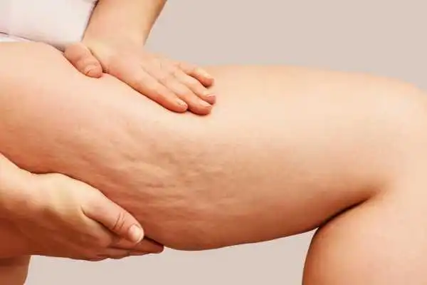 Image of woman showing leg with cellulite Cirencester
