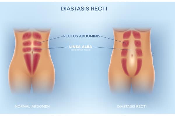 What Non-Surgical Options Are Available for Diastasis Recti Cirencester?