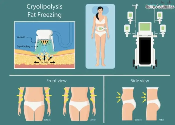 Fat freezing treatment Cirencester benefits for competitions to remove stubborn fat deposits.