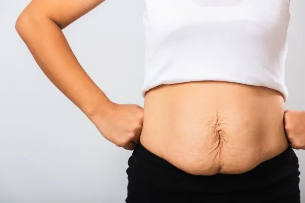 Image of a woman's stomach after weight loss with sagging skin following a gastric band Cirencester