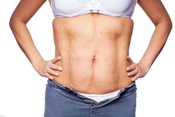 sagging skin on woman's stomach after weight loss injections Cirencester