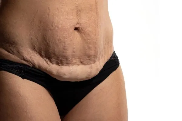 Image of womans stomach after weight loss injections Cirencester showing saggy skin