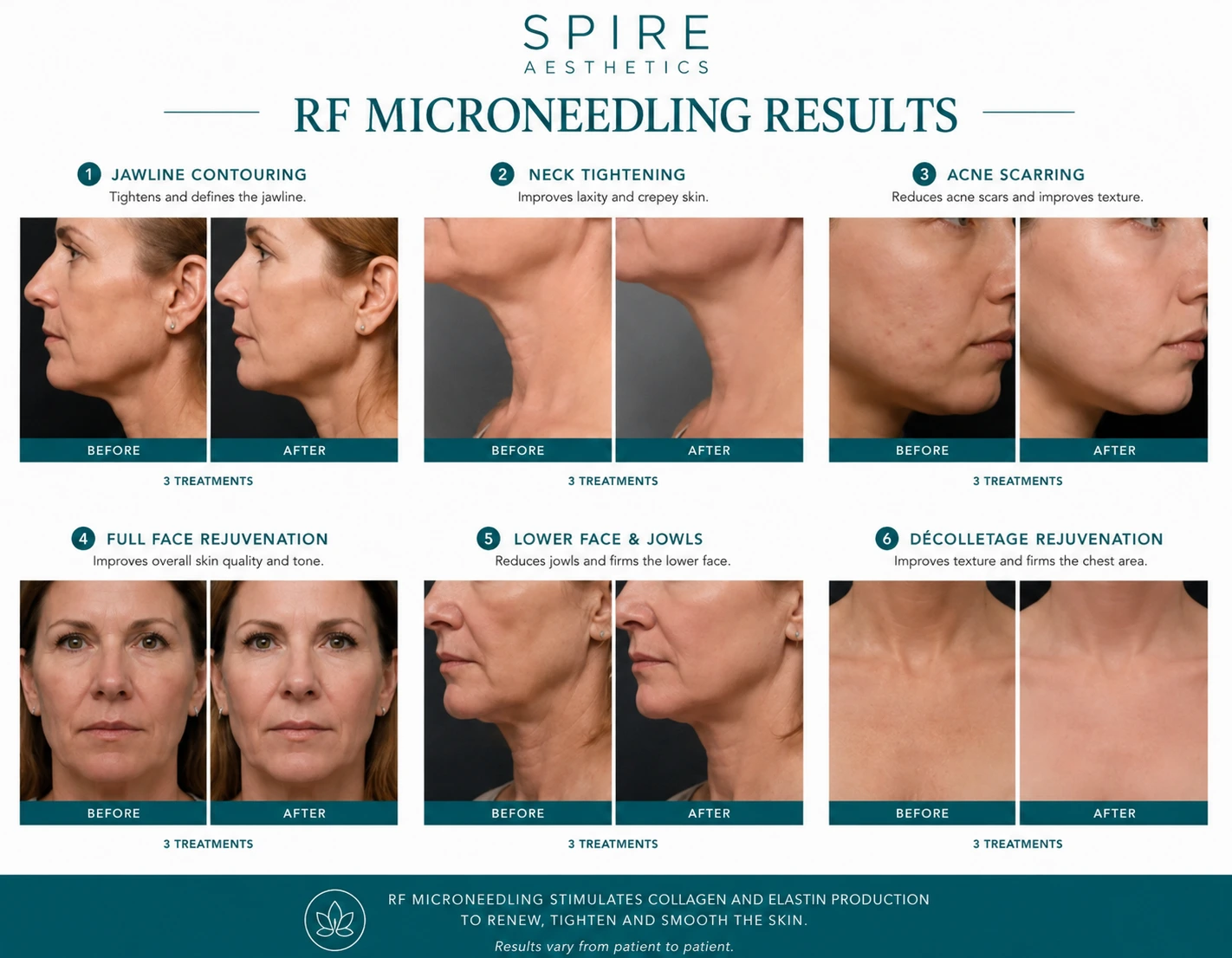 RF Microneedling Skin tightening Cirencester results