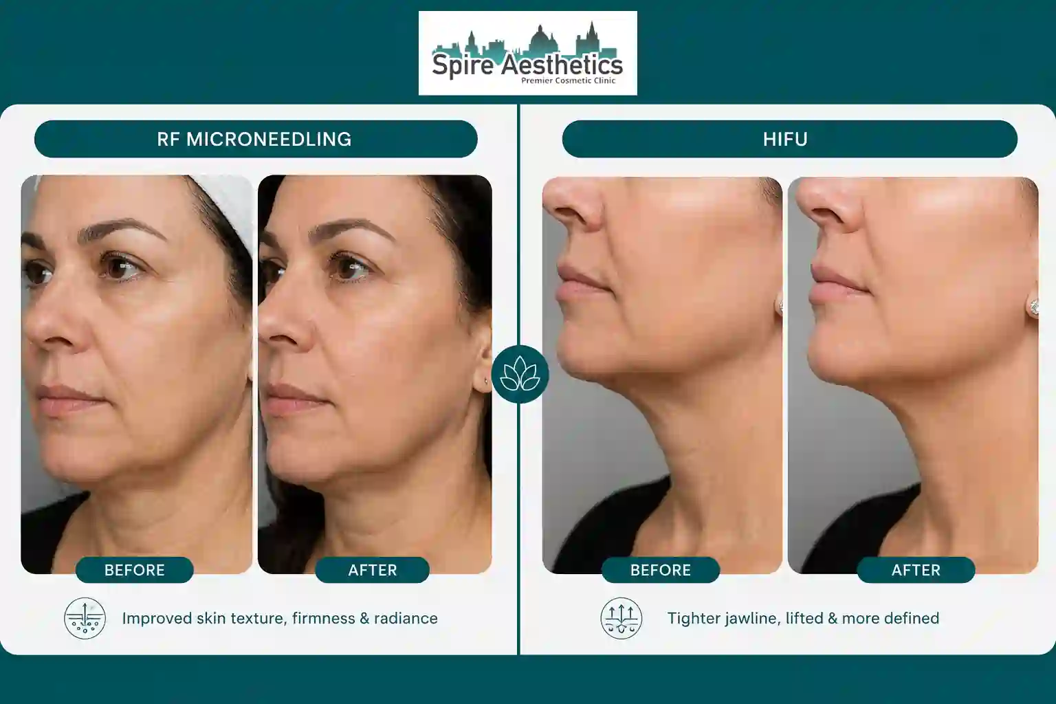 Can RF Microneedling and HIFU Be Combined Cirencester?