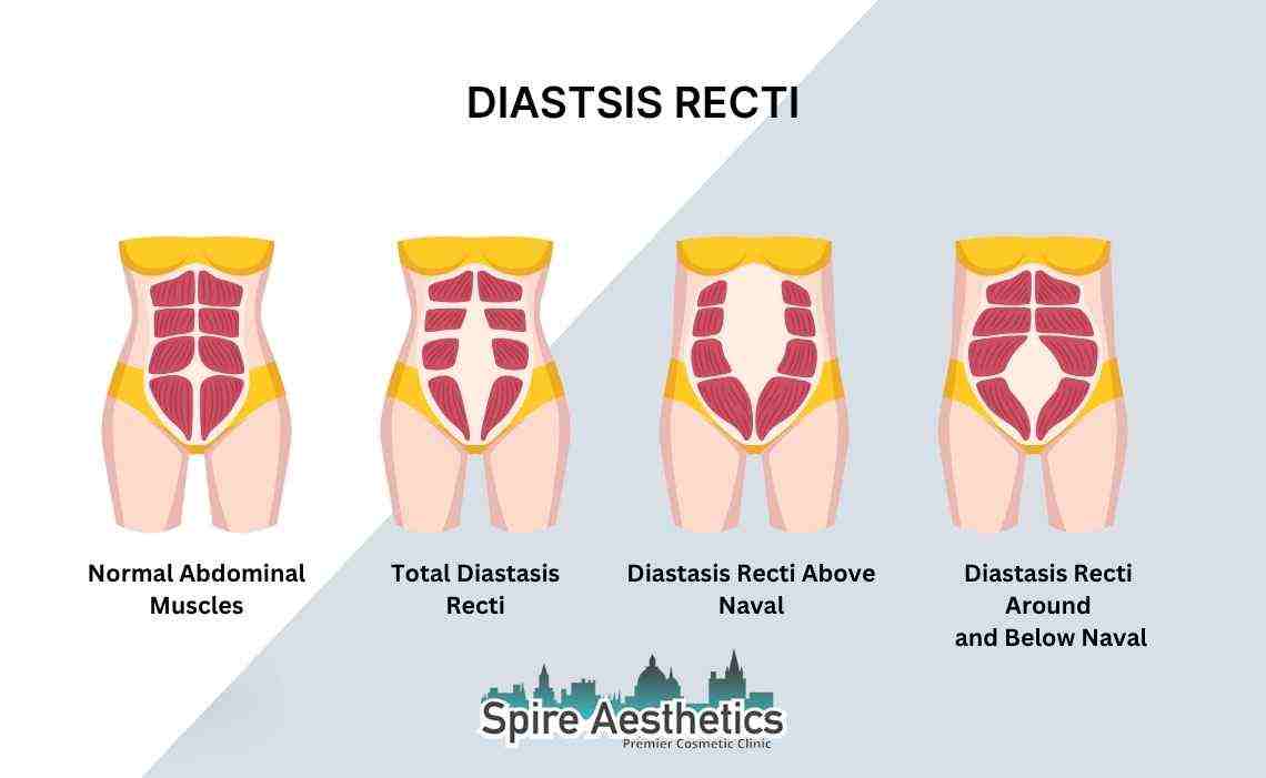 Is Non-Surgical Diastasis Recti Treatment Right for You? Common Concerns Answered Cirencester